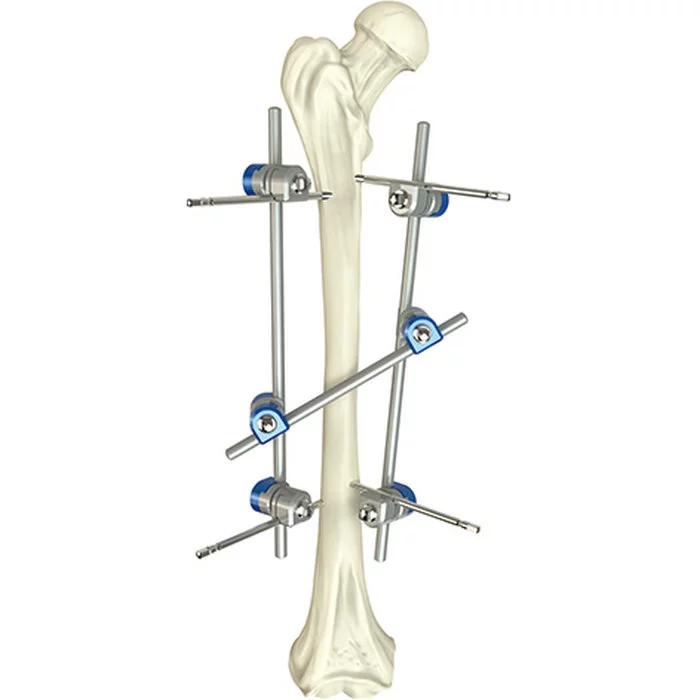 La calidad aseguró los instrumentos médicos quirúrgicos médicos externos de Fixator del eje femoral ortopédico básico del instrumento quirúrgico