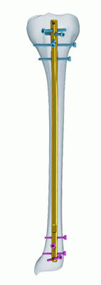 Clavo que entrelaza de la tibia anatómica del CE del titanio