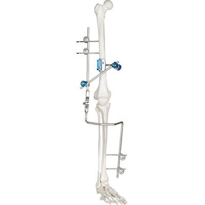 Instrumentos quirúrgicos ortopédicos externos médicos del dispositivo de fijación de la junta de rodilla