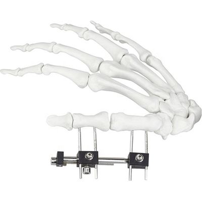 Dispositivo quirúrgico ortopédico de Mini Fragment Ilizarov External Fixation