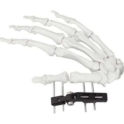 Dispositivo quirúrgico ortopédico de Mini Fragment Ilizarov External Fixation