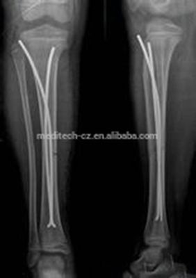 Clavo elástico del titanio ortopédico de los implantes DIEZ para la cirugía de los niños