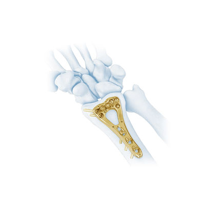 Placa distal II de la fractura del radio de la palma axial multi del trauma